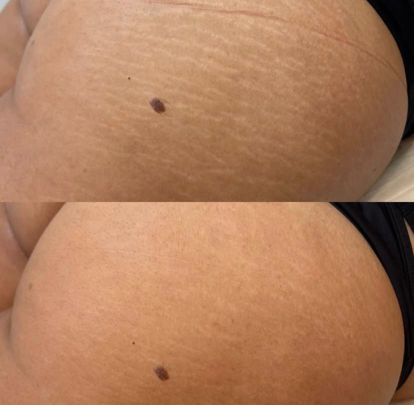 Camuflagem Estética em Farroupilha: Perguntas Frequentes Sobre Estrias, Cicatrizes e Melasma