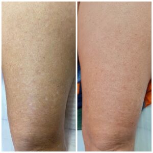 Camuflagem de Estrias, Cicatrizes e Melasma em Farroupilha: Conheça os Tratamentos da Bruna Barbosa Beauty Clinic